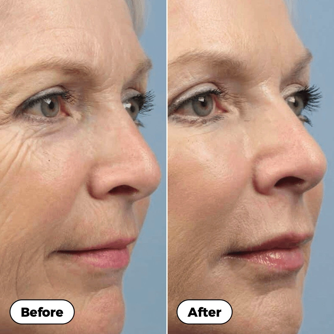 Before and after: profile with softer-looking lines around the eyes and mouth