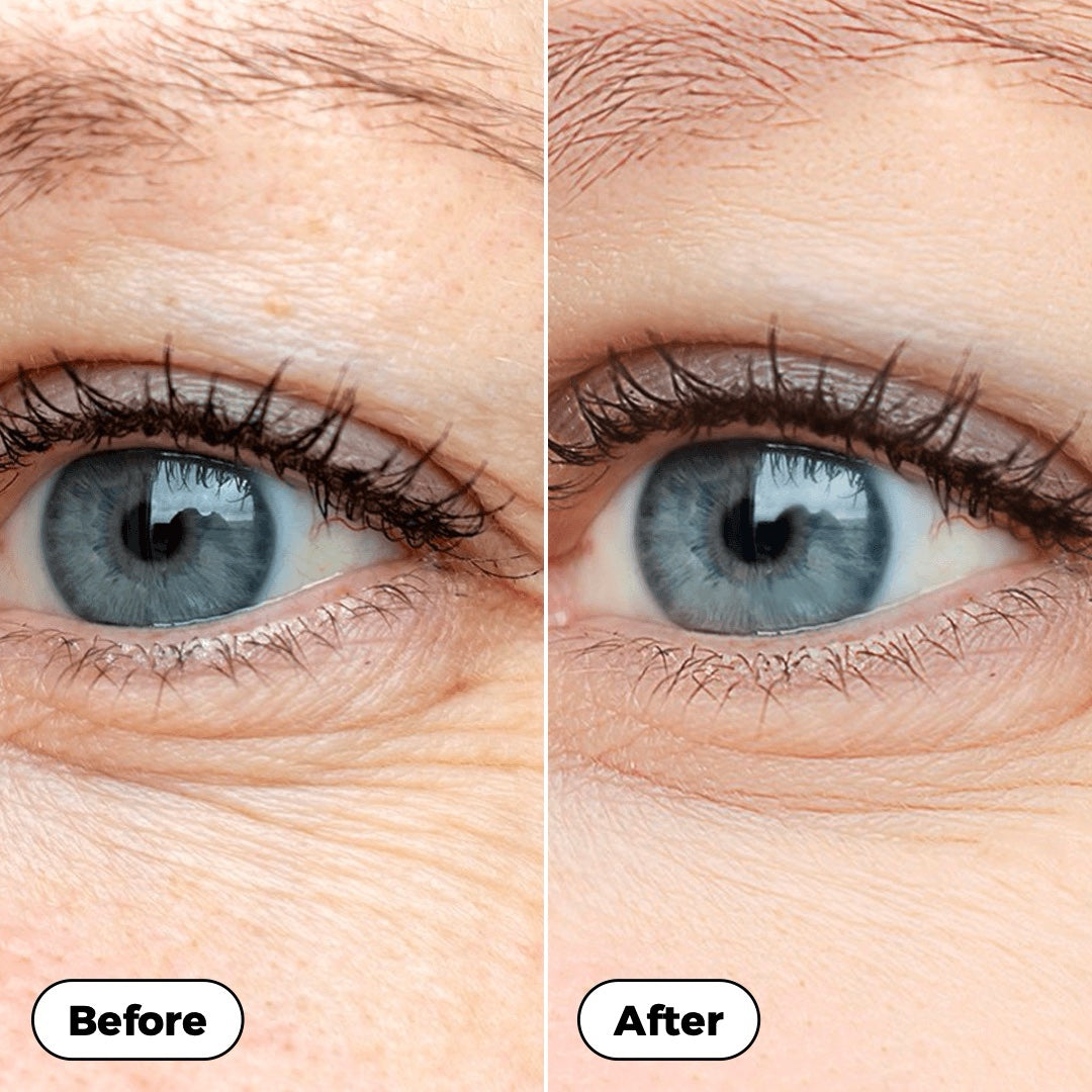 Before and after: close-up of the eye area with fewer visible fine lines